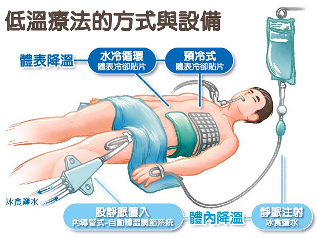 心肌梗塞心肺停止　急救、放支架、低溫療法救命